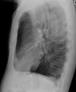 Figure S1. Chest x-ray appears normal. Related to Figure 1.
