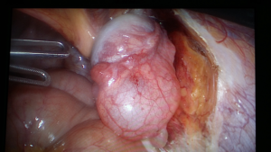 Figure S1. Intraoperative photos showing the ovary as the content of the right femoral hernia.