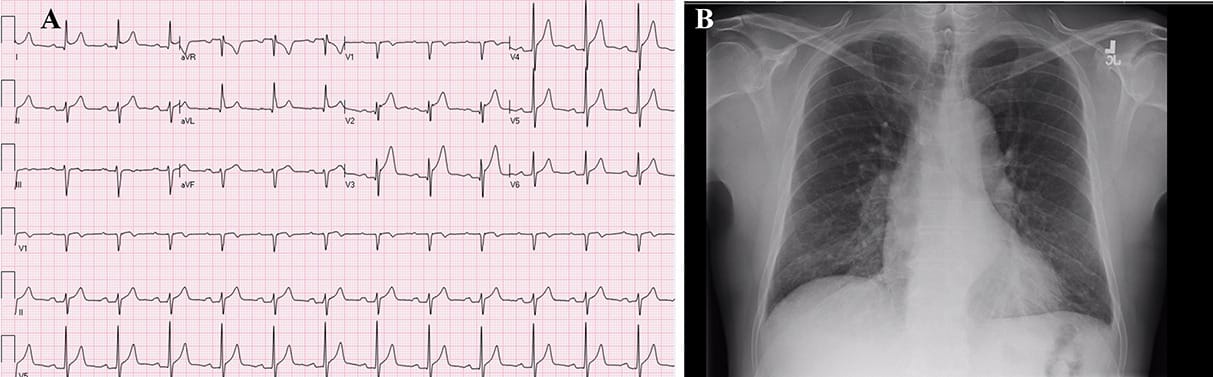 Case Report: Type 1 aortic dissection presenting as acute pericarditis ...
