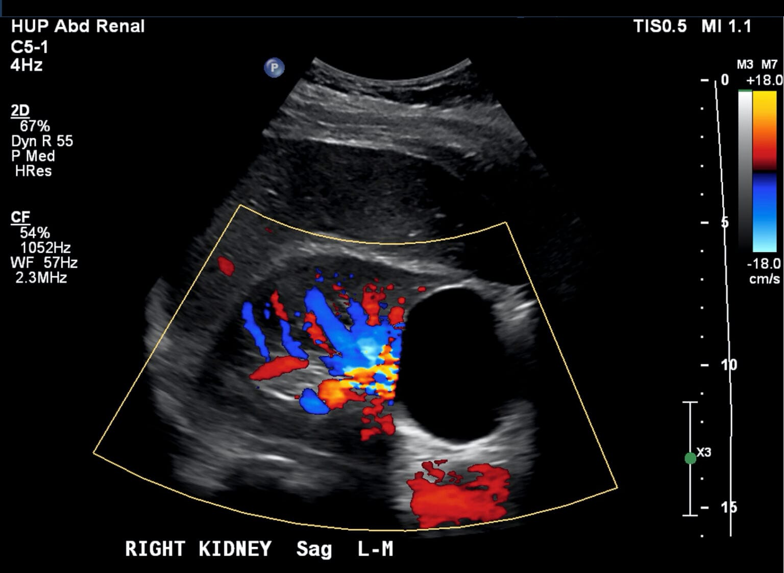 Infected Baker's cyst, diagnosed in the emergency department using ...