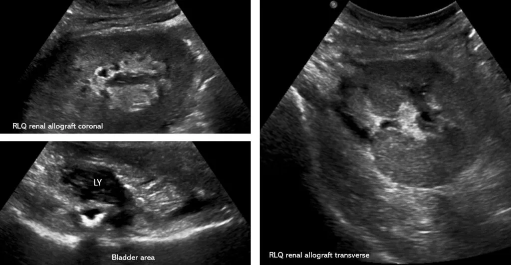 Massive Lymphocele Associated with Allograft Hydronephrosis: An