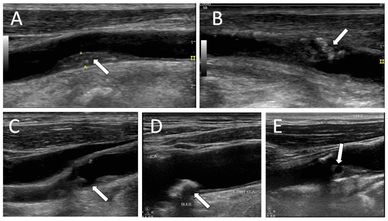 Pictorial Essay of Cervical Duplex Ultrasonography - POCUS Journal