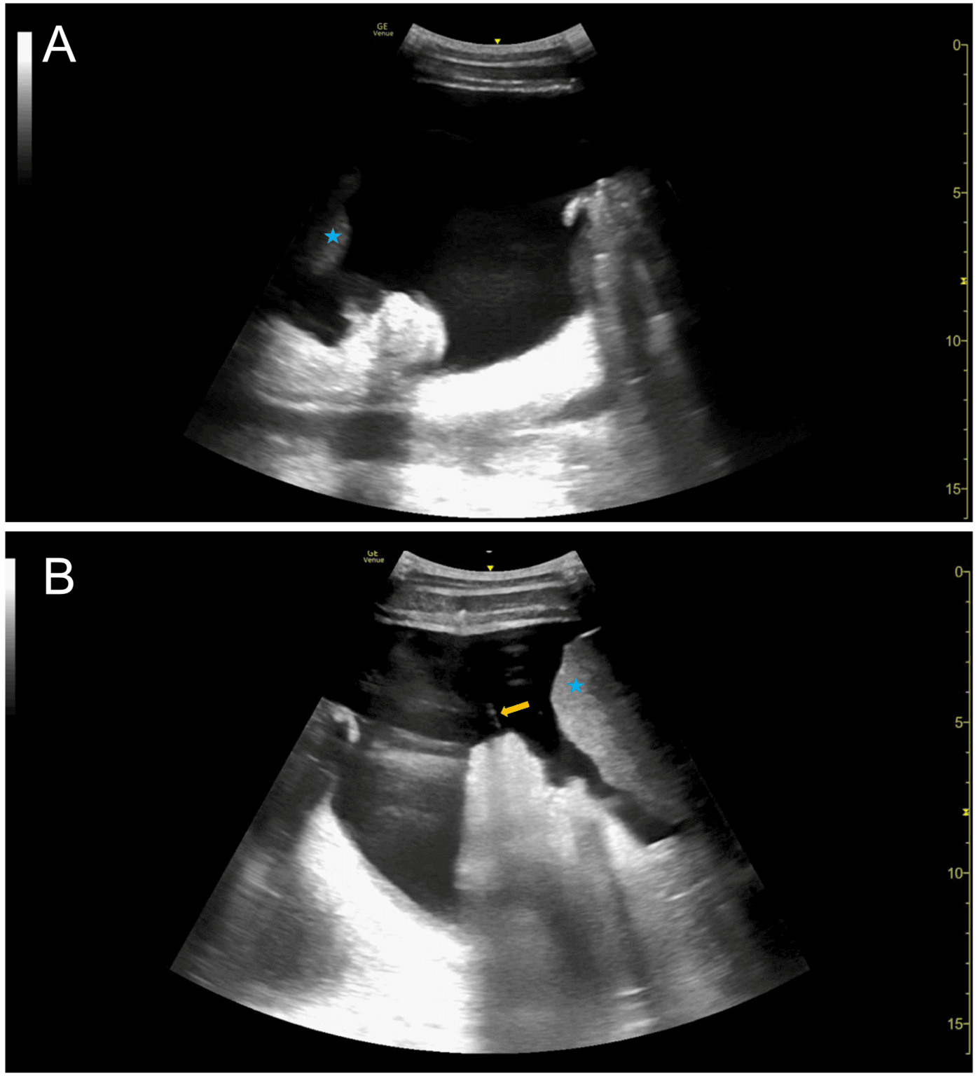Point-of-Care Ultrasound for the Diagnosis of Colon Cancer - POCUS Journal