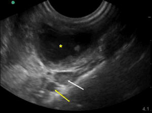 The Use of Point of Care Ultrasound in Diagnosis of Peritonsillar ...