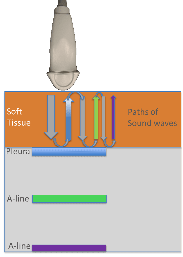 Rib Reverberation: An Important New Artifact in Lung Ultrasound - POCUS ...