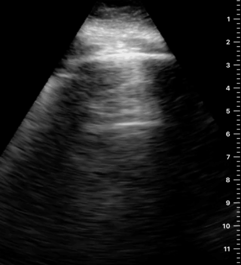Specttcular Rib Rib Reverberation: An Important New Artifact in Lung Ultrasound - POCUS ...