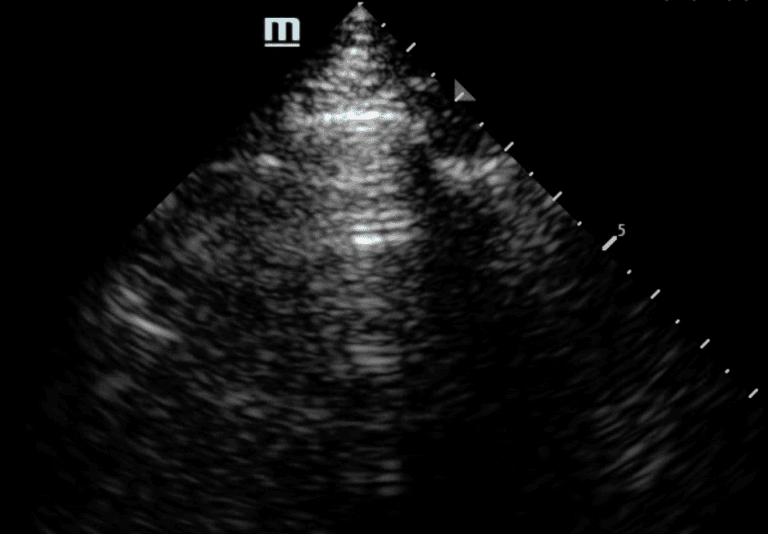 Ultrasound For Rib Example Rib Reverberation: An Important New Artifact in Lung Ultrasound - POCUS ...