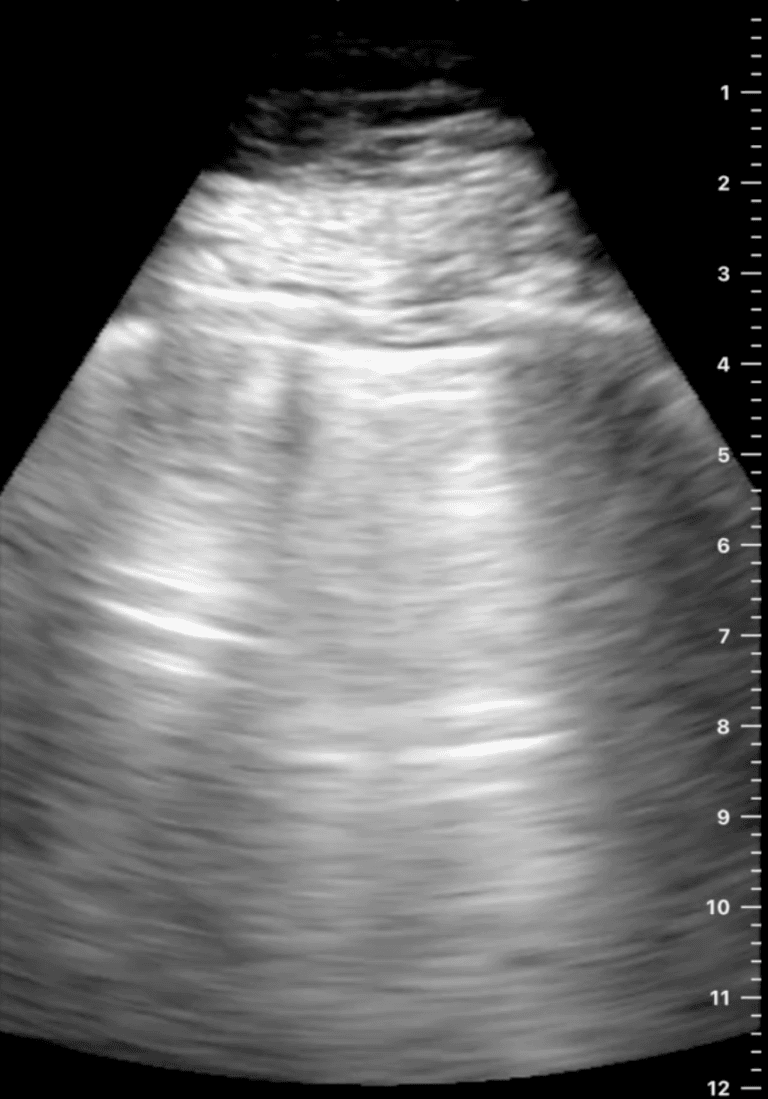 Rib Reverberation: An Important New Artifact in Lung Ultrasound - POCUS ...