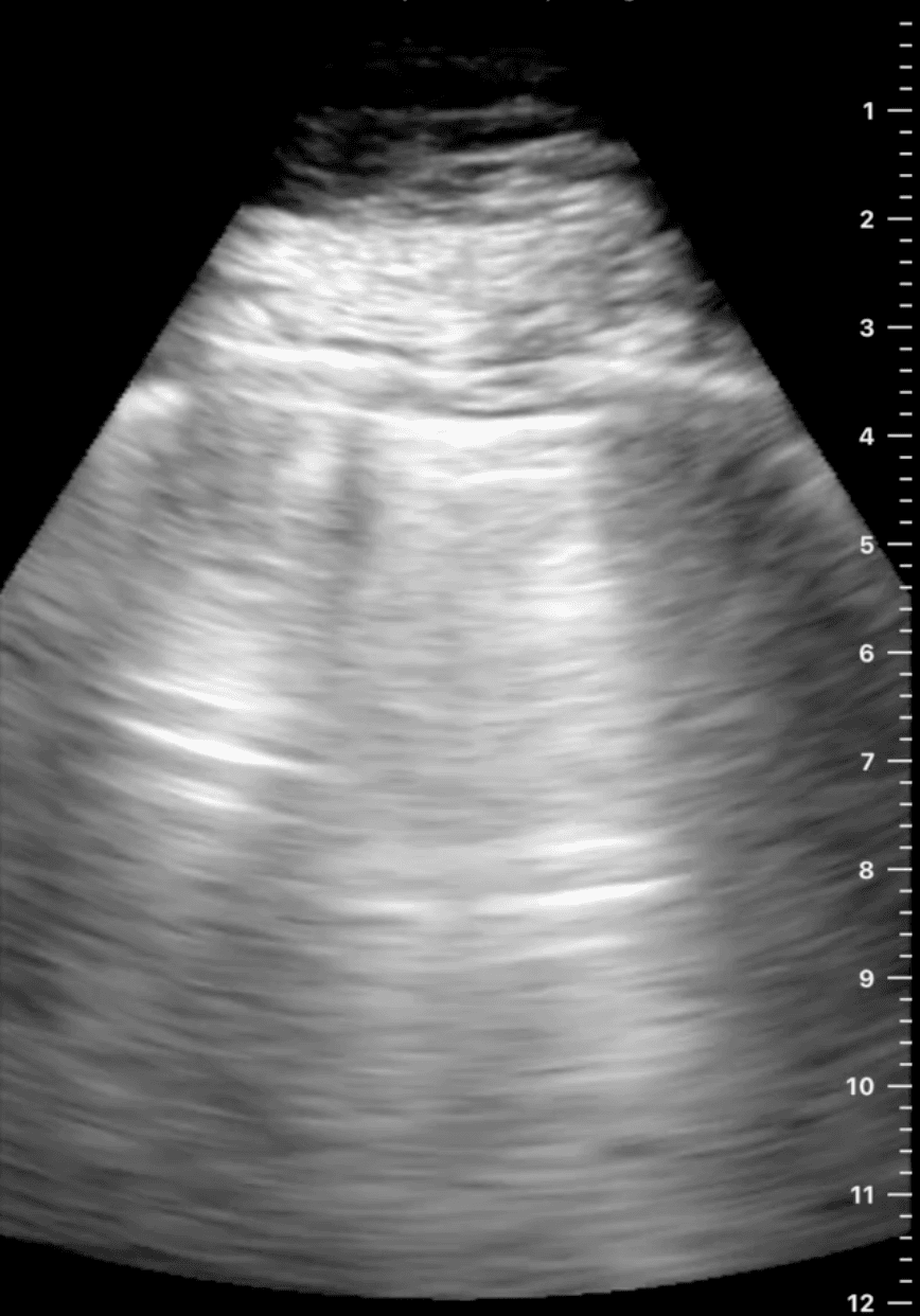 Rib Reverberation: An Important New Artifact in Lung Ultrasound - POCUS ...
