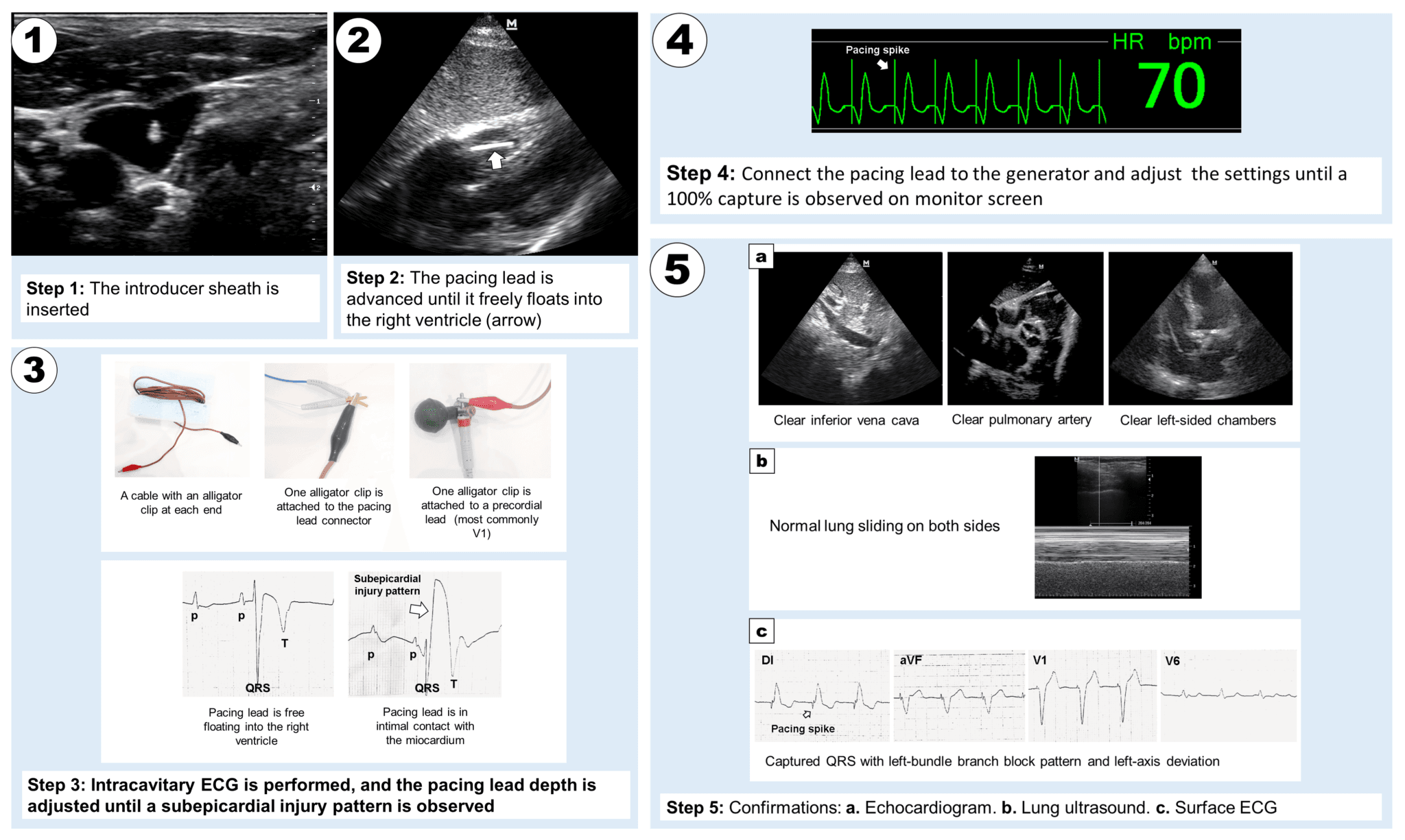 Perforation of the Interventricular Septum by a Temporary Transvenous ...