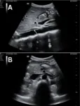Grayscale POCUS images of a 25-year-old female standardized patient showing (A) sagittal view with a linear, hyperechoic structure within the lumen of the abdominal aorta and (B) transverse view with a normal, anechoic lumen of the abdominal aorta.